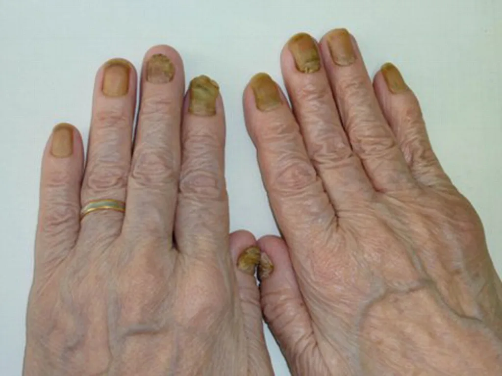 longest fingernails in the world