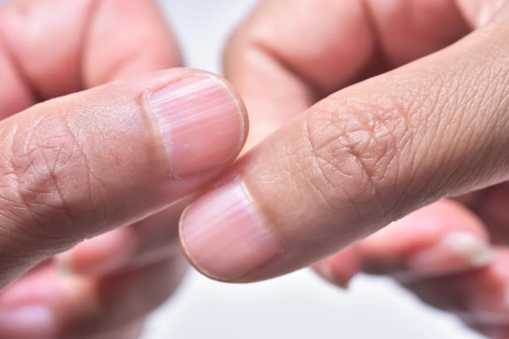 ridges on fingernails