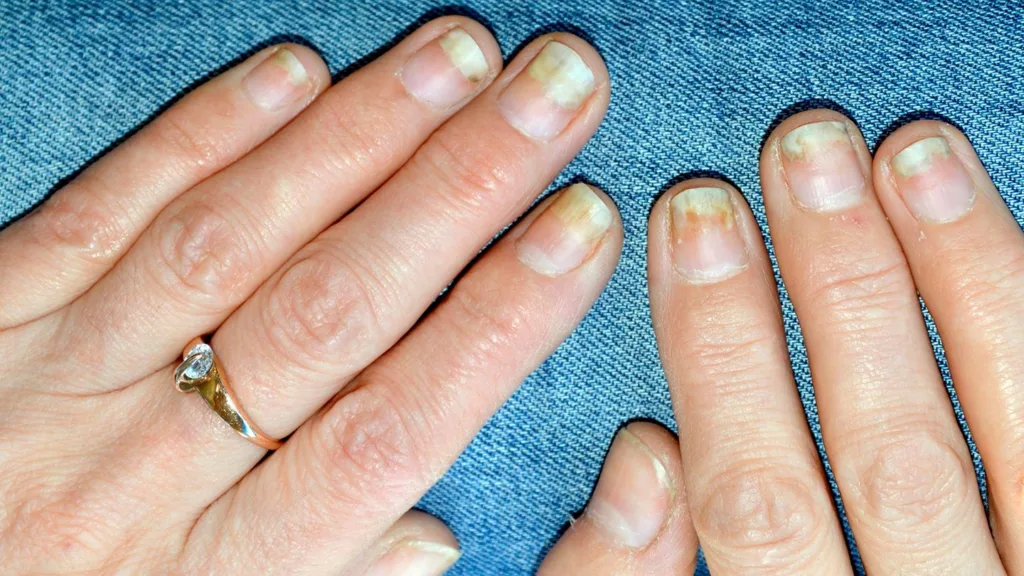 purple fingernails